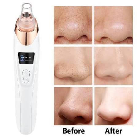 Professional 5-in-1 Blackhead Remover – Derma Suction Pore Cleansing Beauty Tool